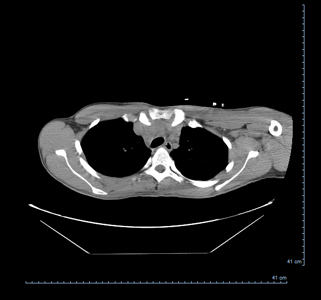 tumor2